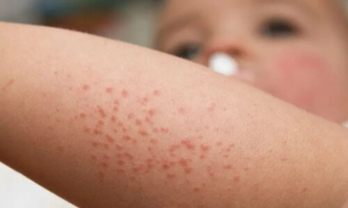 how to treat bed bug bites on babies