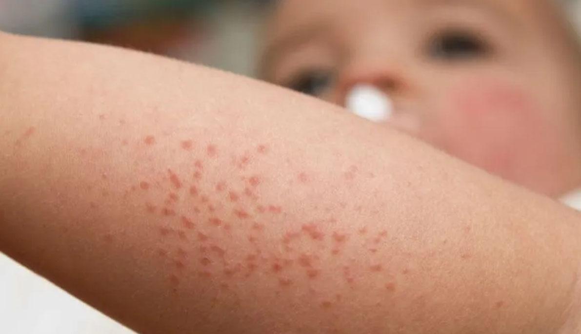 how to treat bed bug bites on babies